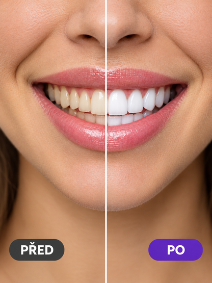 DentaLuxe bělící pásky (Smilekit) - nová verze